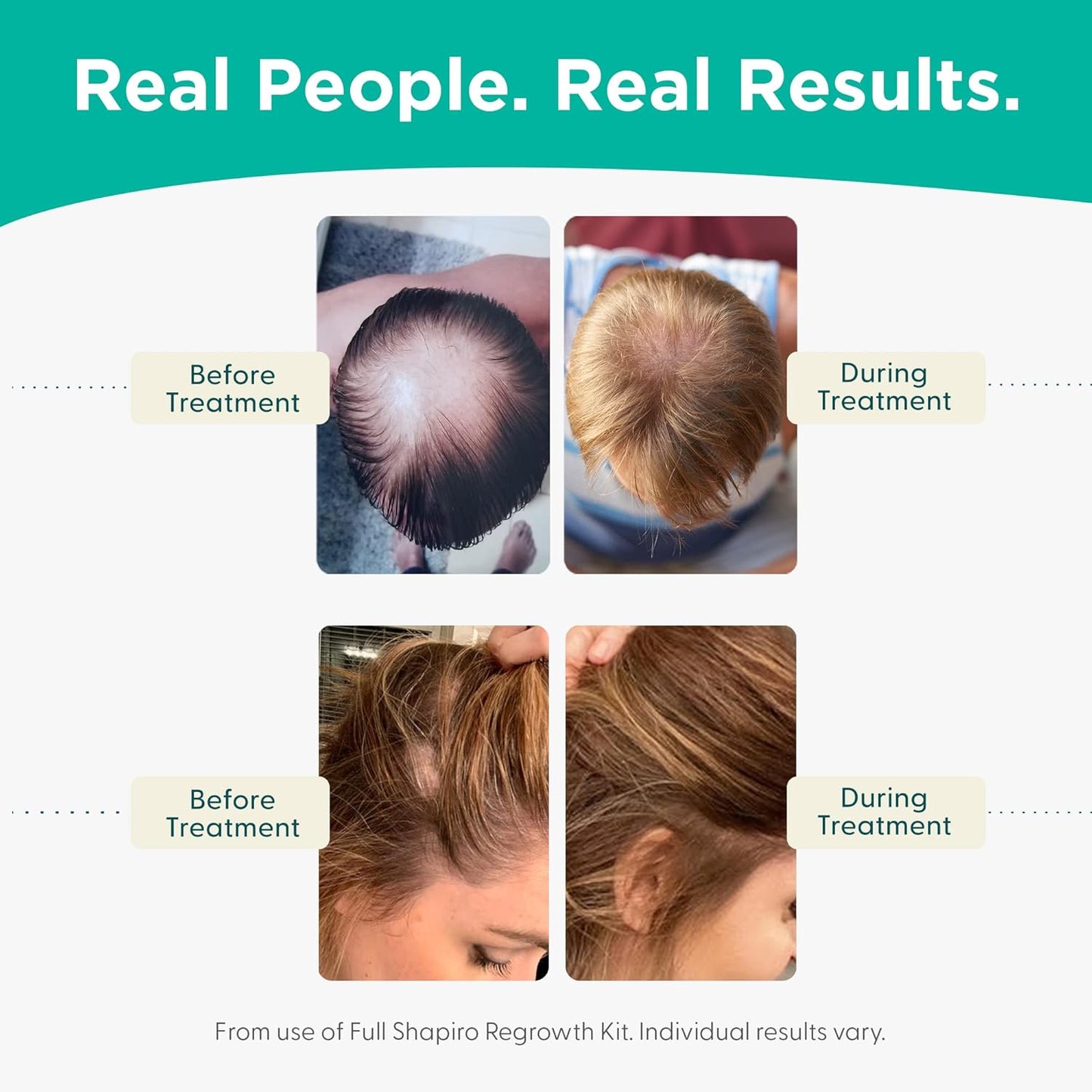 Shapiro MD Hair Growth Experts Leave-In Daily Foam, DHT Fighting Vegan Formula for Thinning Hair Developed by Dermatologists, Experience Healthier, Fuller & Thicker Looking Hair - 4 Month Supply
