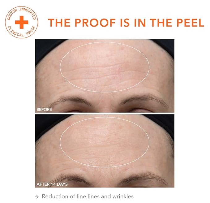 Dr. Dennis Gross Alpha Beta Ultra Gentle Daily Peel: for Dehydrated or Sensitive Skin, Uneven Tone or Texture, Fine Lines or Enlarged Pores (5 Treatments)