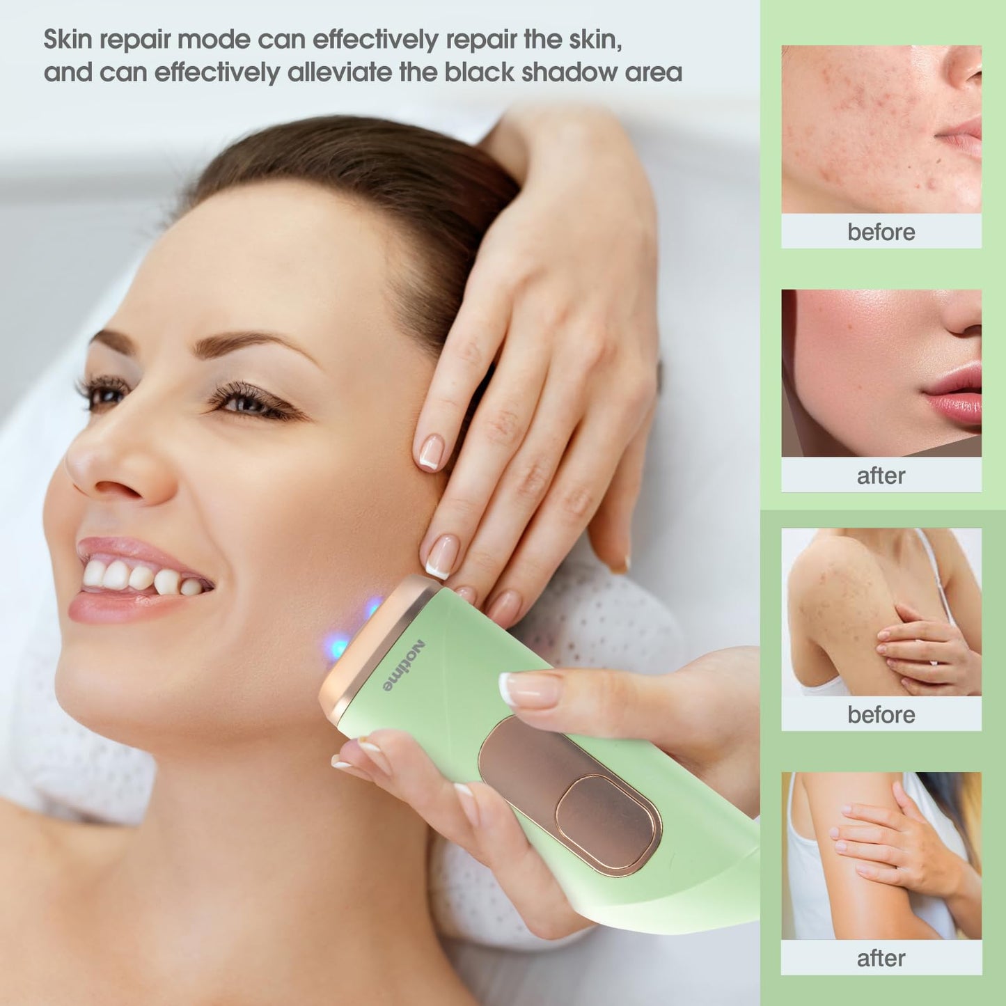ICELADY Cooling Hair Removal Device, Hair Removal for Women and Men, Painless Permanent Hair Removal System on Full Body