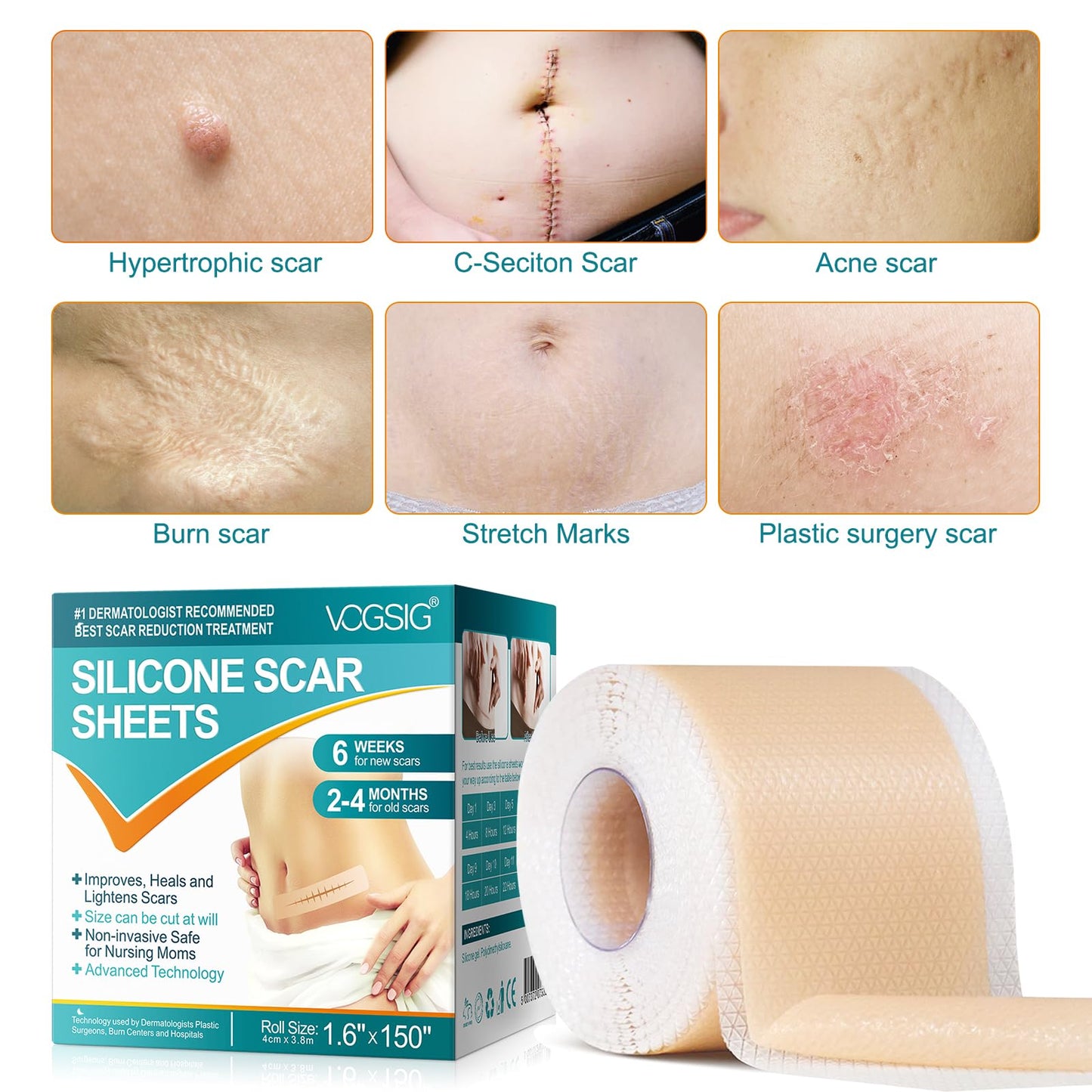 Generic Silicone Scar Sheets,Silicone Scar Tape Roll for Scar Removal(1.6”x150”-3.8M),Reusable Waterproof Professional Soft Silicone Tape, Yellow