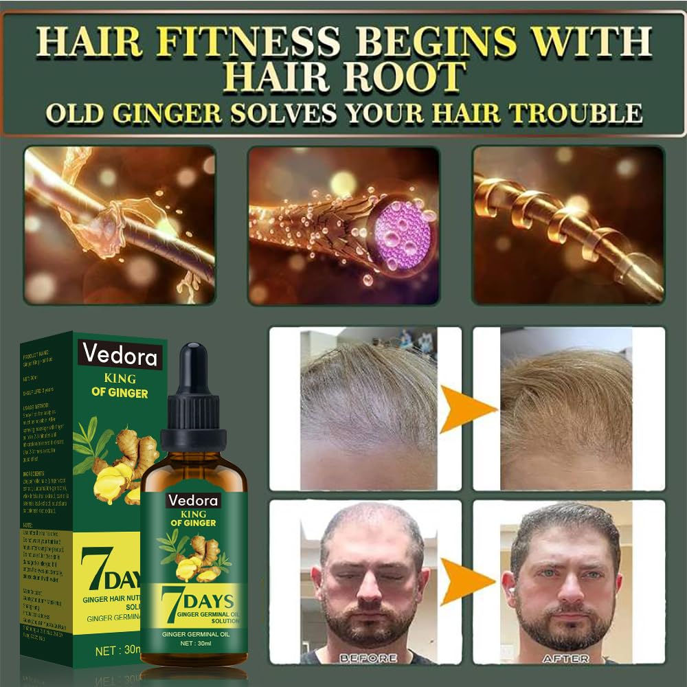 Vedora King of Ginger Oil for Hair Growth - Biotin Hair Growth Serum, 100% Pure Natural Ginger Essential Oil - Promotes Stronger, Thicker, Longer Hair in Women & Men - 3.15 Fl Oz / 90ML (3 PCS)
