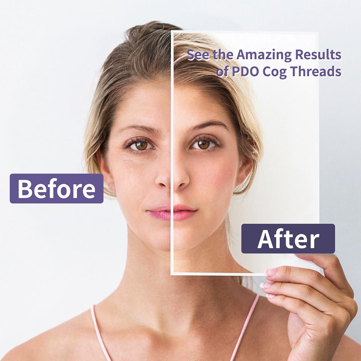 Elves PDO Nose Thread Lift/Nasal 4d COG Pdo Threads for Nose Columella Nose Bridge Nose Dorsum Lift/L-Blunt Type, 20PCS (19G 60mm)