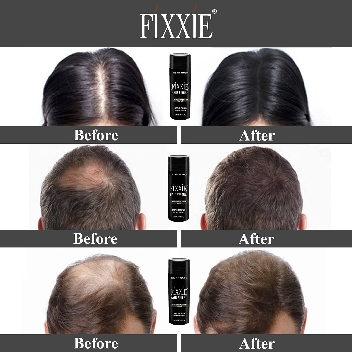 FIXXIE Hair Fibers MEDIUM BROWN for Thinning Hair 27.5g Bottle, Hair Fibre Concealer for Hair Loss for Men and Women, Naturally Thicker Looking Hair with Keratin Hair Fibres