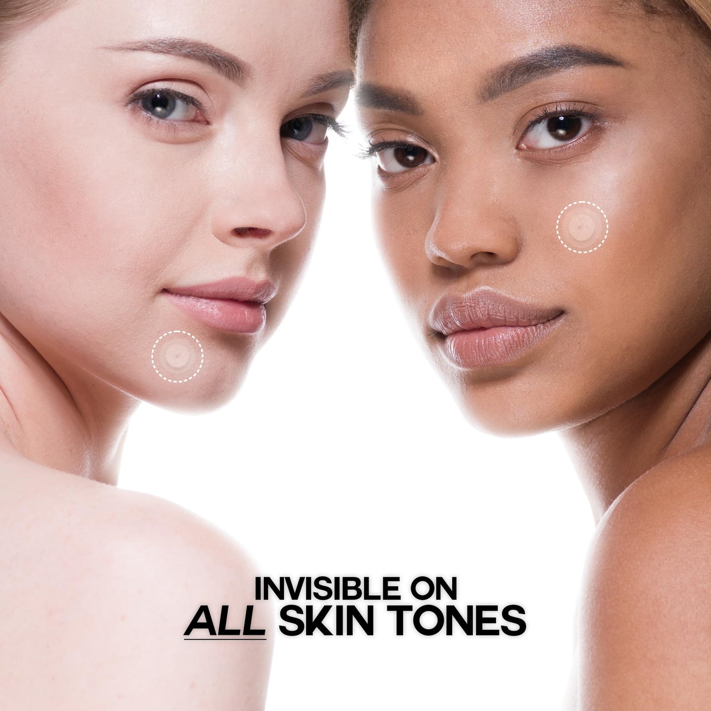 Epielle Over-Zit Acne Clear Patches | Ultimate Hydrocolloid Solution | 138 Acne and Blemish Patches for Clear Skin